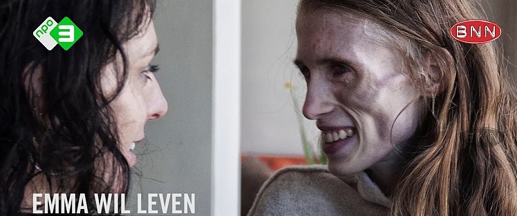 anorexia